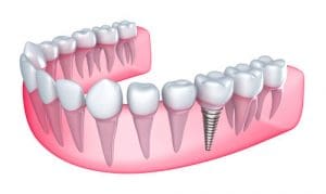 dental implants Brighton MA